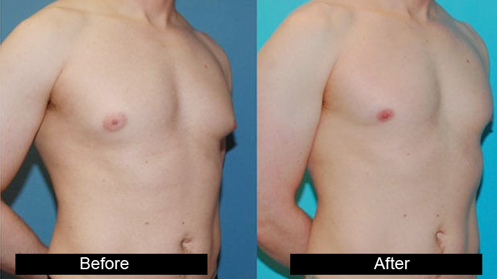 male breast reduction treatment in Kartarpur