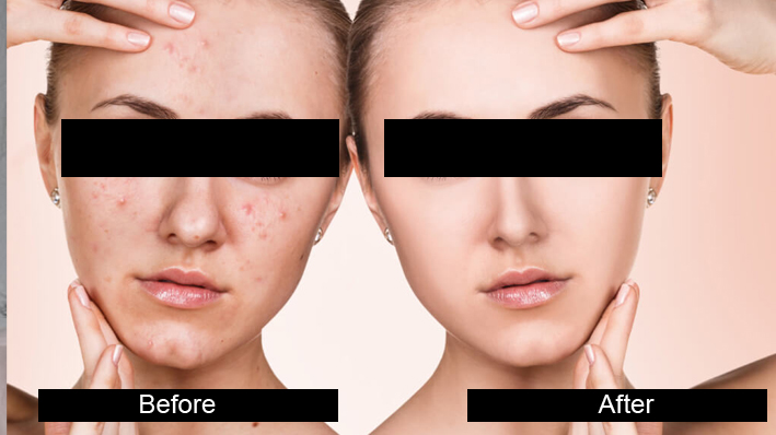 Facial Scar Reduction treatment in jalandhar