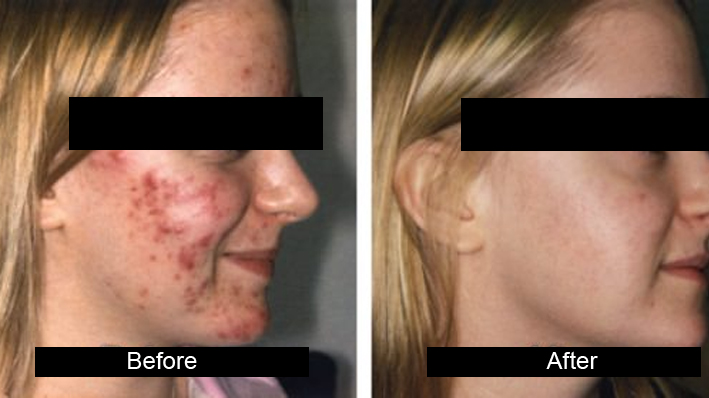 Facial Scar Reduction in jalandhar