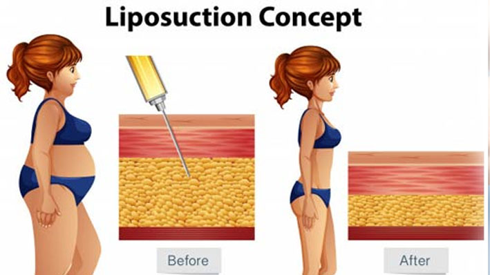 liposuction treatment in Shahkot