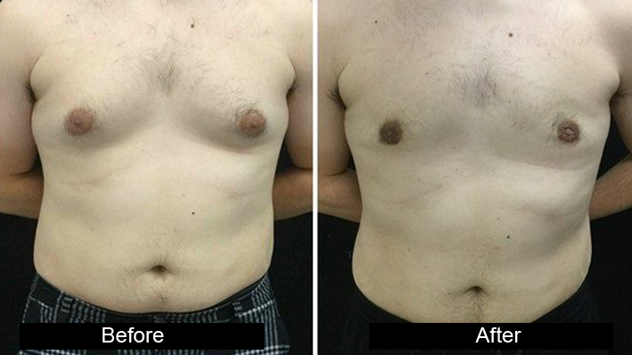 male breast reduction in Sultanpur Lodhi