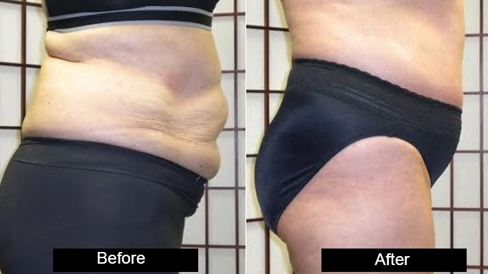 Non Surgical Fat Reductions in jalandhar