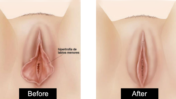 vaginoplasty in jalandhar
